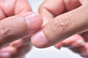 The Lowdown on Ridged Nails: Causes, Concerns, and Care
